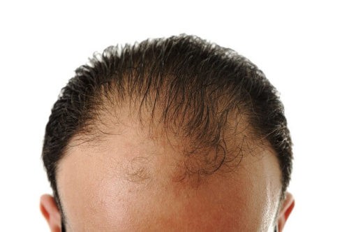 To recede means to move further away. A man has a receding hairline if his hair loss starts in the front and moves back or recedes.